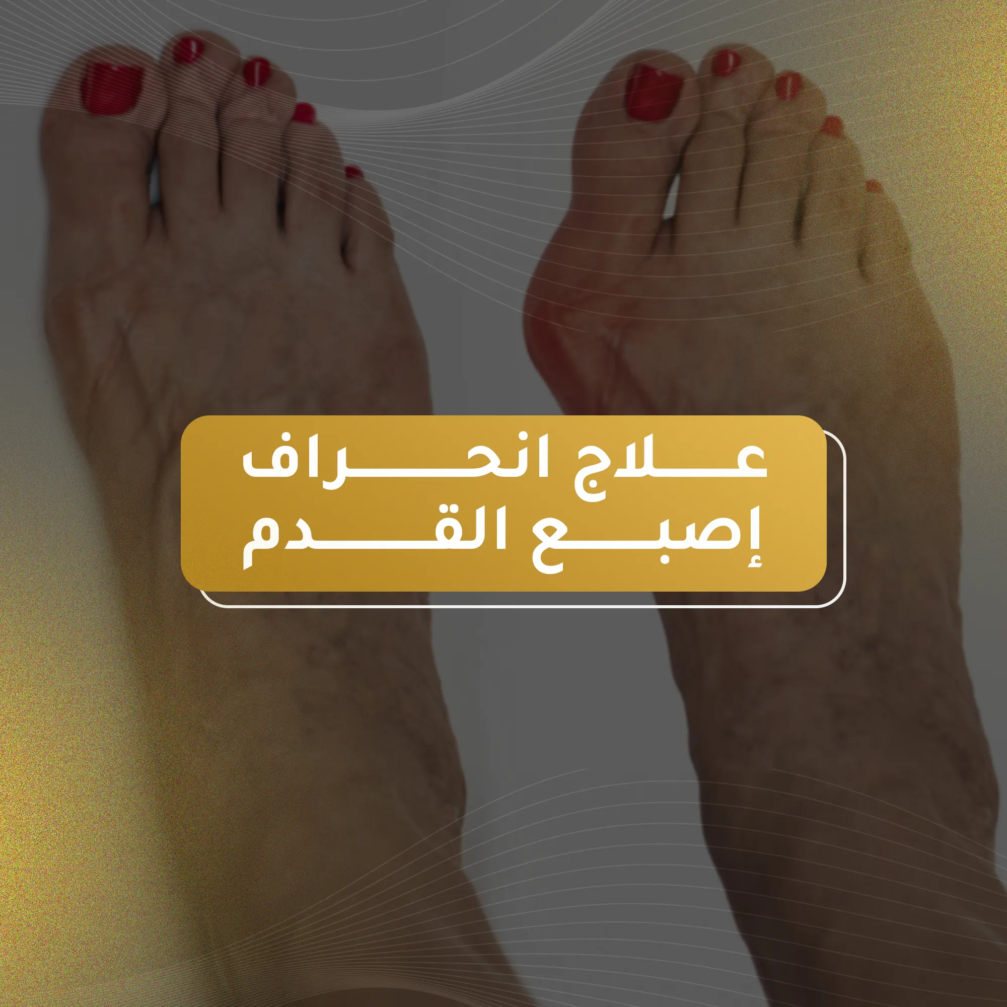 علاج انحراف إصبع القدم