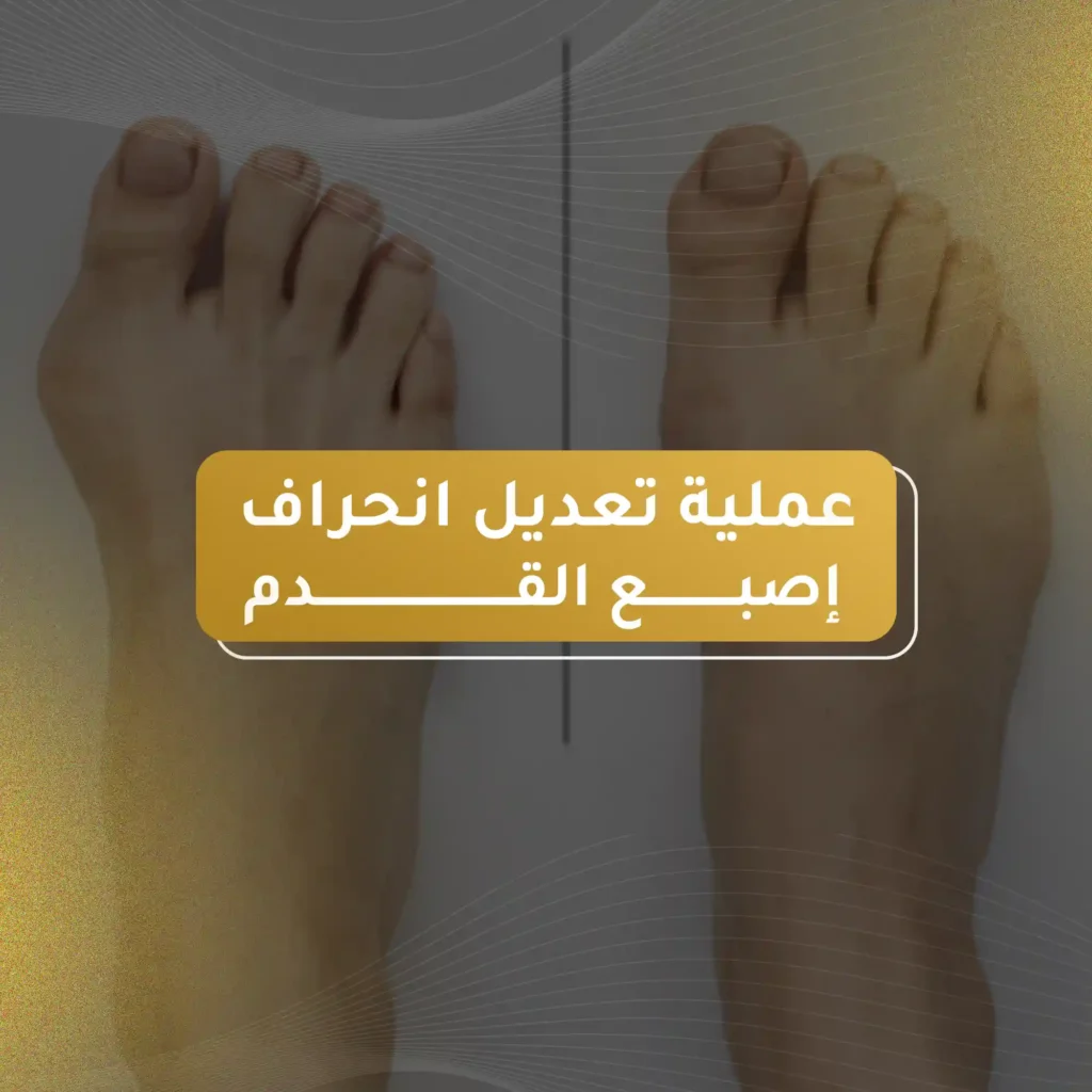 عملية تعديل انحراف اصبع القدم