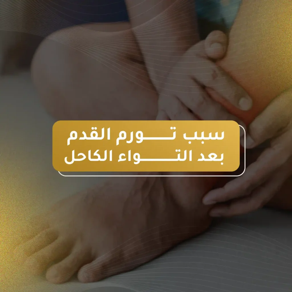 سبب تورم القدم بعد التواء الكاحل