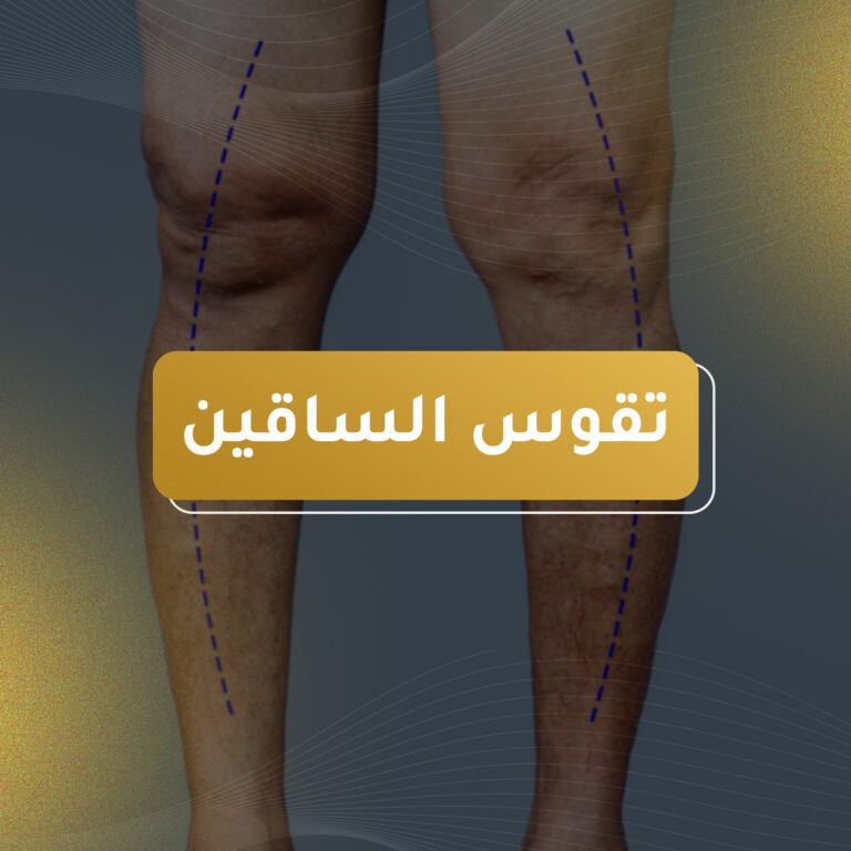 تقوس الساقين